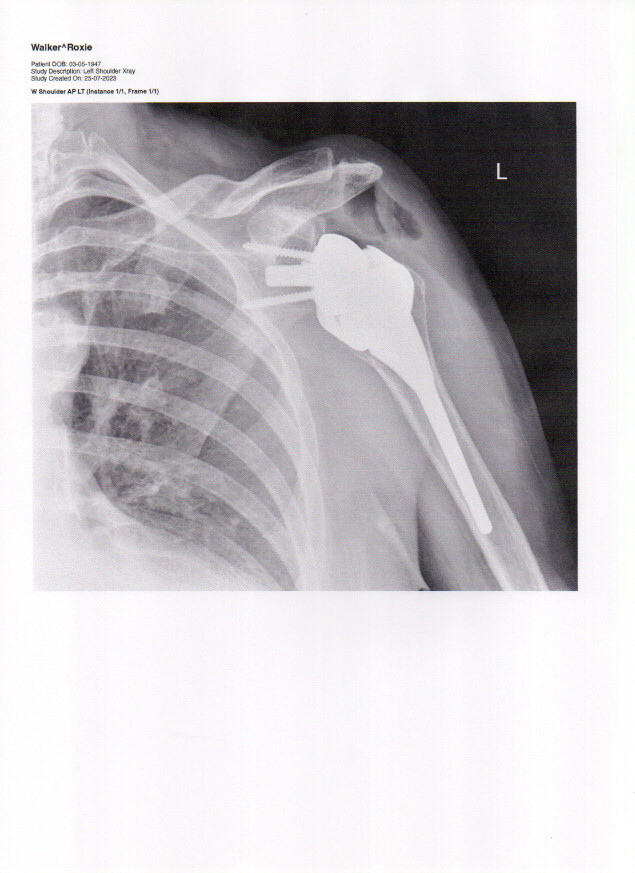 Shoulder x-ray 25 July 2023 copy